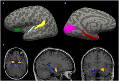 The Influence of Aging, Hearing, and Tinnitus on the Morphology of Cortical Gray Matter, Amygdala, and Hippocampus
